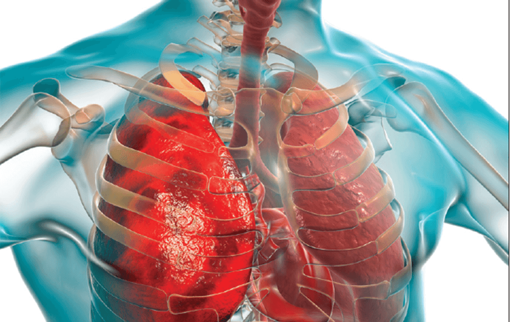 Faster-Diagnostic-Tests-Developed-for-TB-1