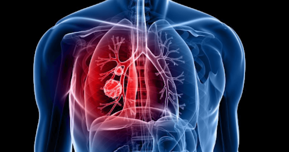 AI blood testing technology developed to detect lung cancers