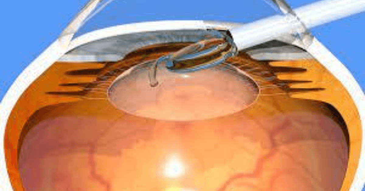 A New Ray Of Hope For Cataract Patients_featured image