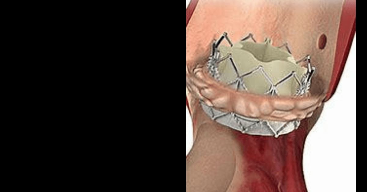 Sapien3 Transcatheter Pulmonary Valve System With Alterra Adaptive Pre-stent