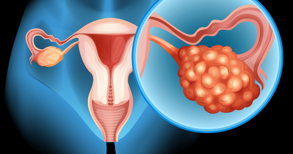 Adolescent Polycystic ovarian syndrome An entity well known but still unknown