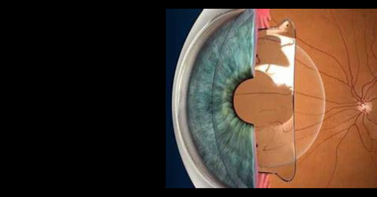Perks Of Lenses And Laser Surgery Combined For Better Opthalmic Outcome_featured image