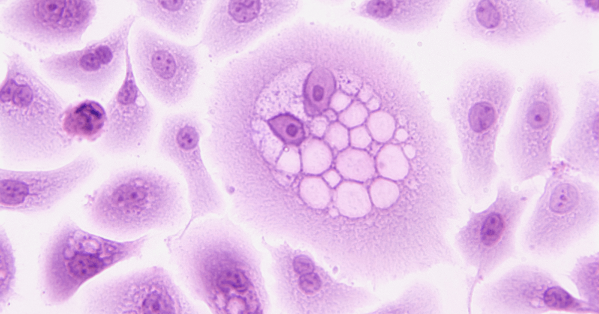 Evolving Biomarkers in Pathology Unveiling new avenues for disease detection and prognosis